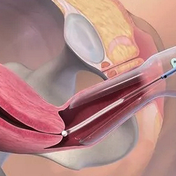 Радиоволновая биопсия шейки матки