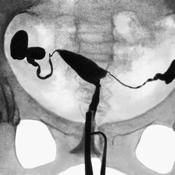 Рентген маточных труб на проходимость